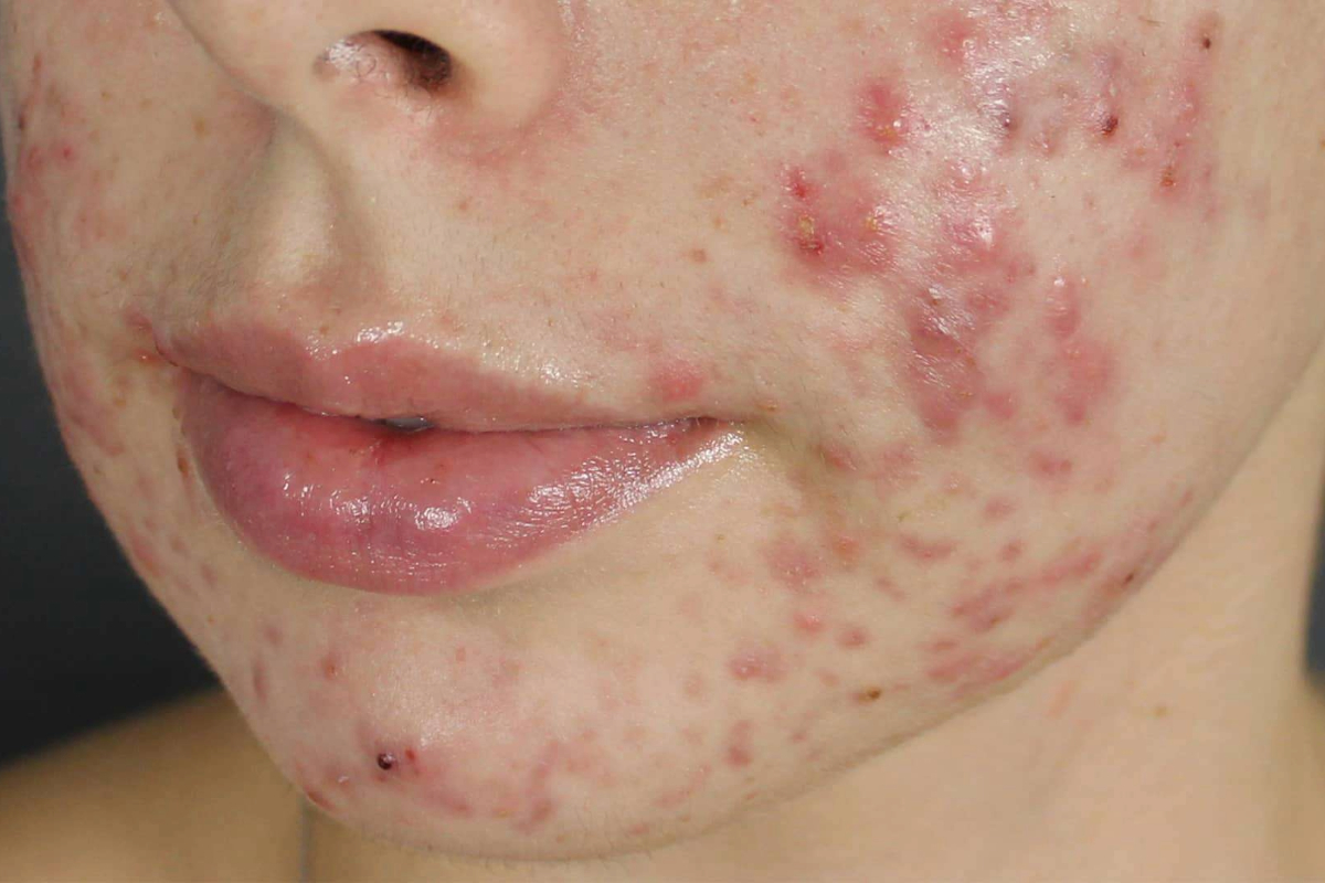 Breakouts / Congestion